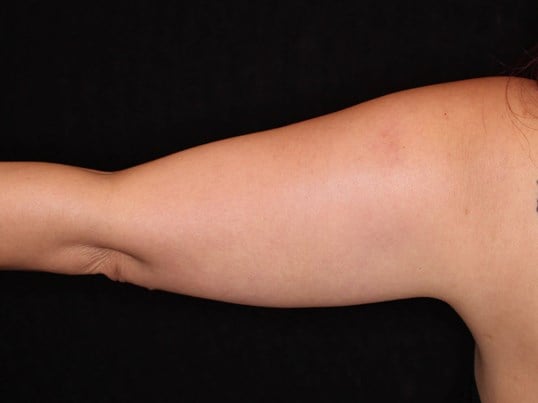 Awake Liposuction Arms After