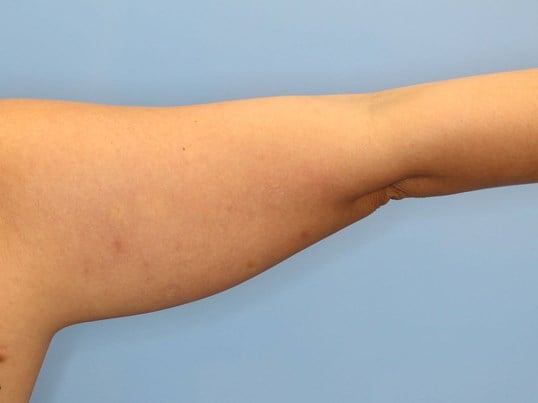 Awake Liposuction Arms Before