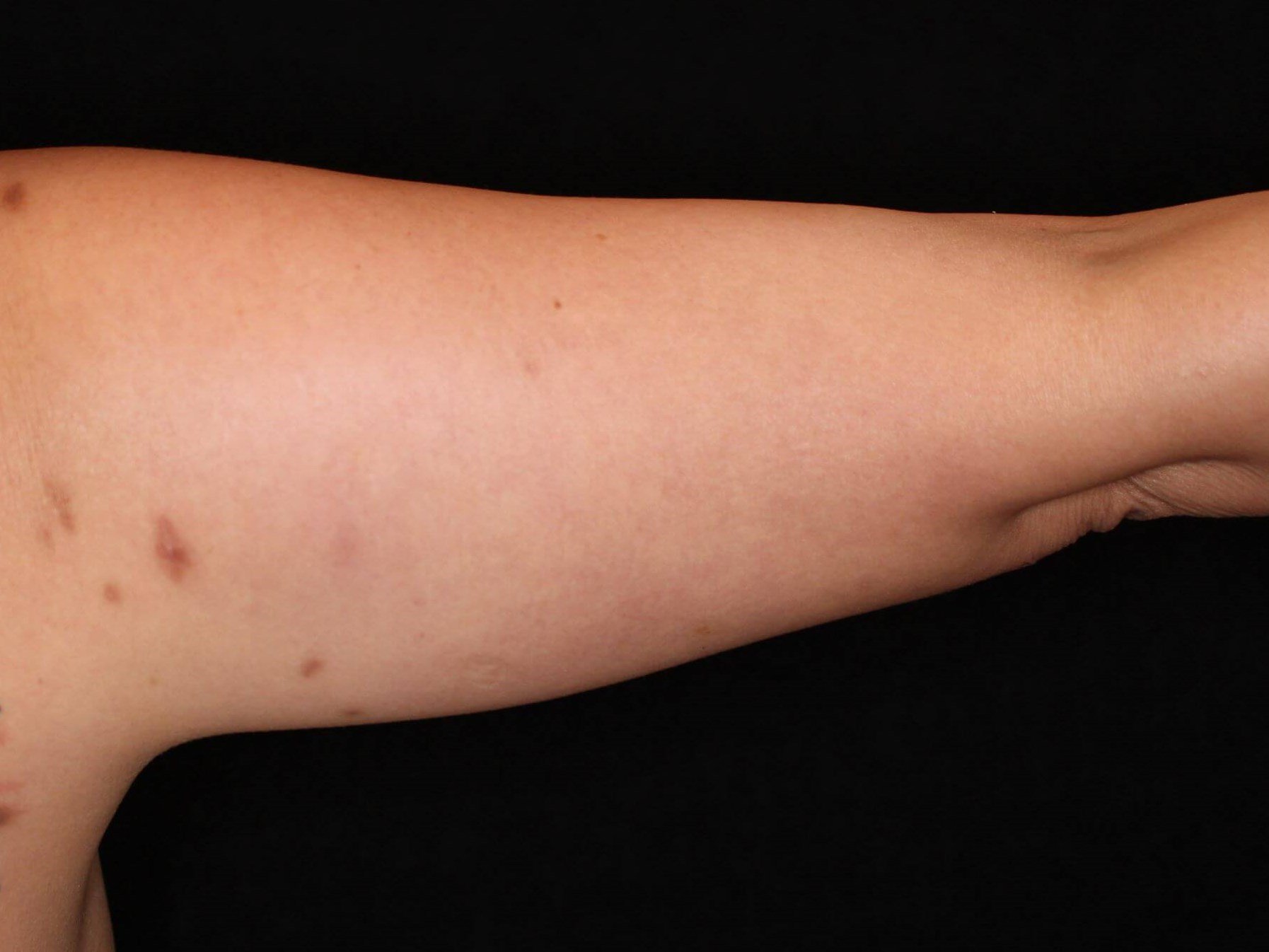 Awake Liposuction Arms After