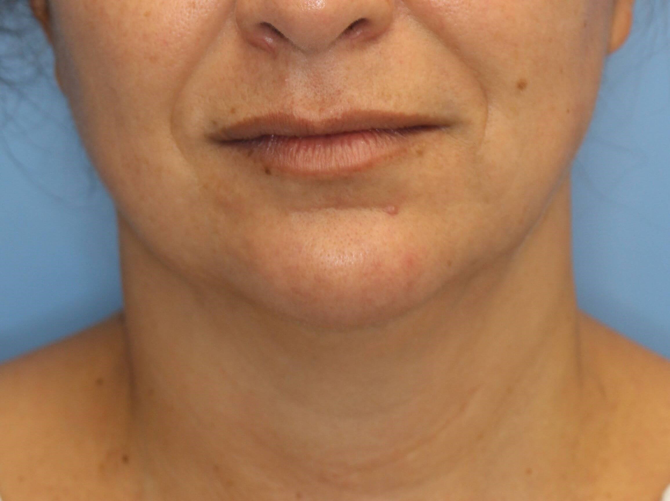 Nonsurgical Jaw Contouring Before