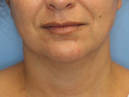 Nonsurgical Jaw Contouring Before