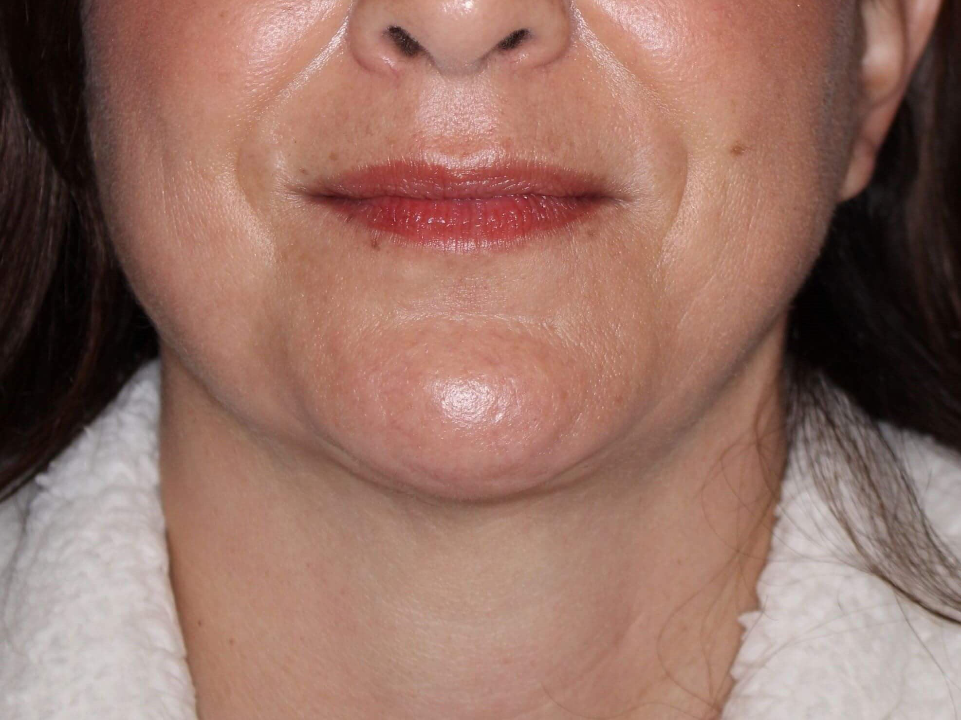 Nonsurgical Jaw Contouring After
