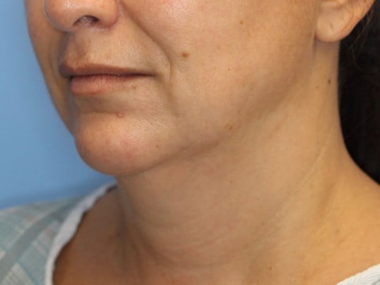 Nonsurgical Jaw Contouring Before