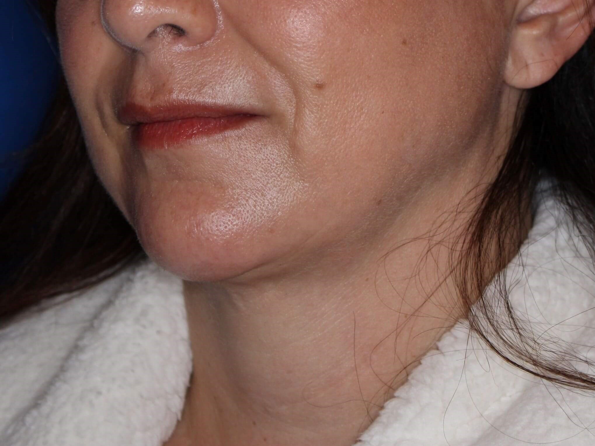 Nonsurgical Jaw Contouring After