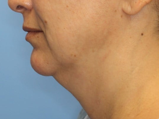 Nonsurgical Jaw Contouring Before