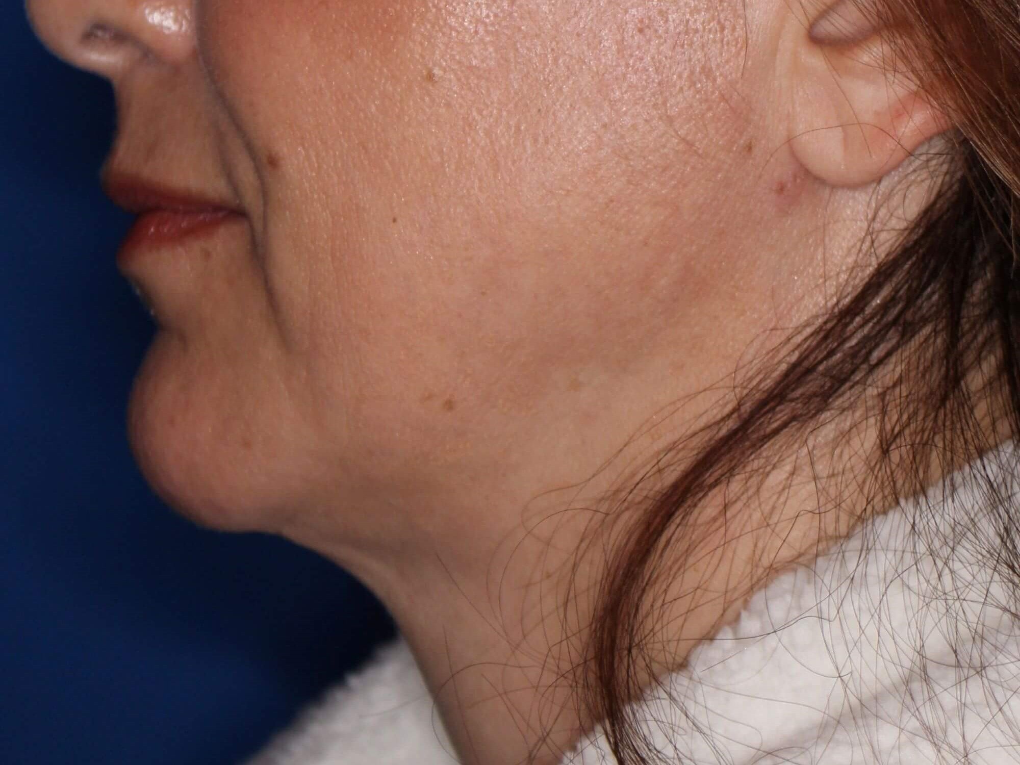 Nonsurgical Jaw Contouring After