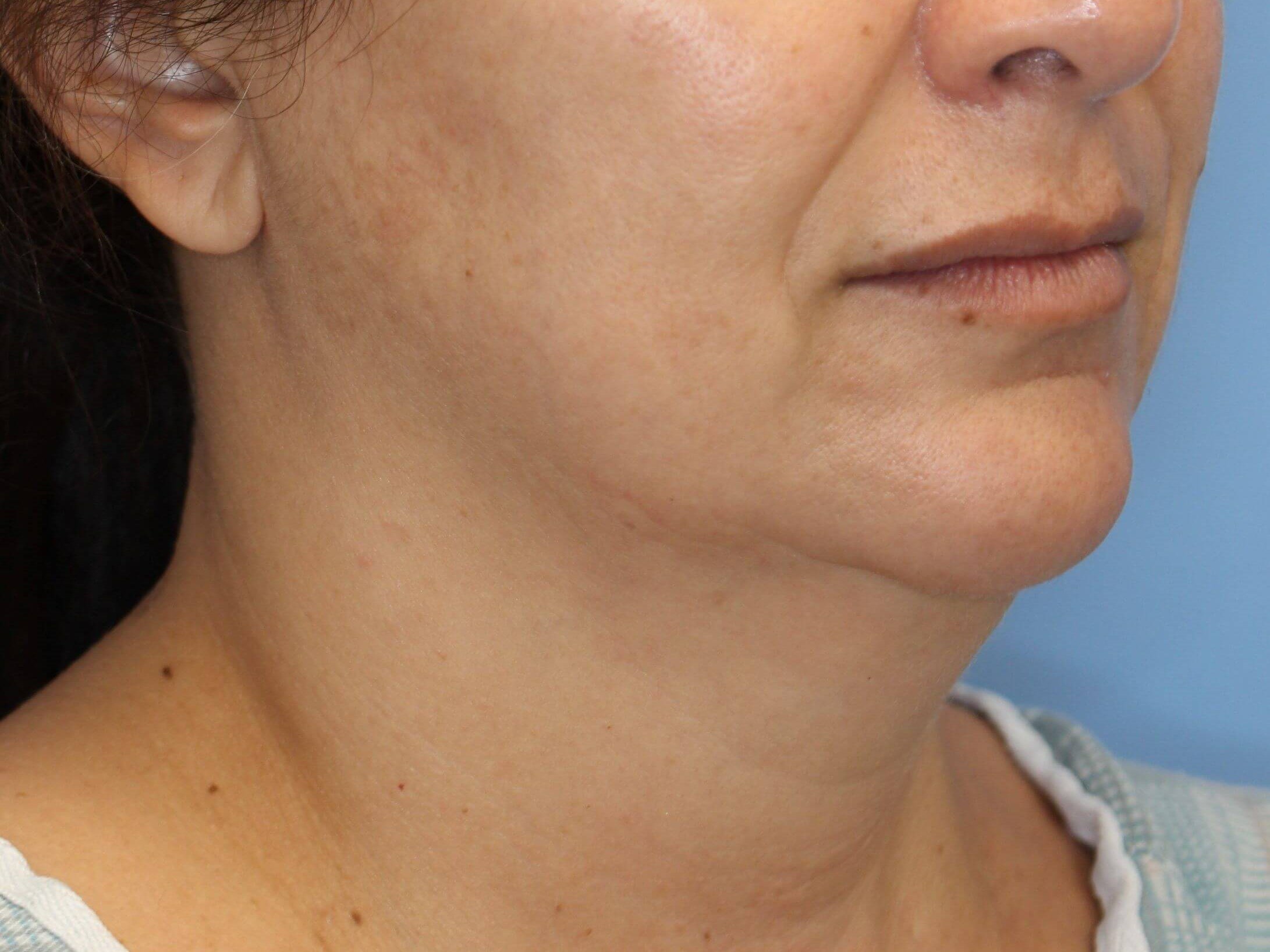 Nonsurgical Jaw Contouring Before