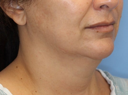 Nonsurgical Jaw Contouring Before