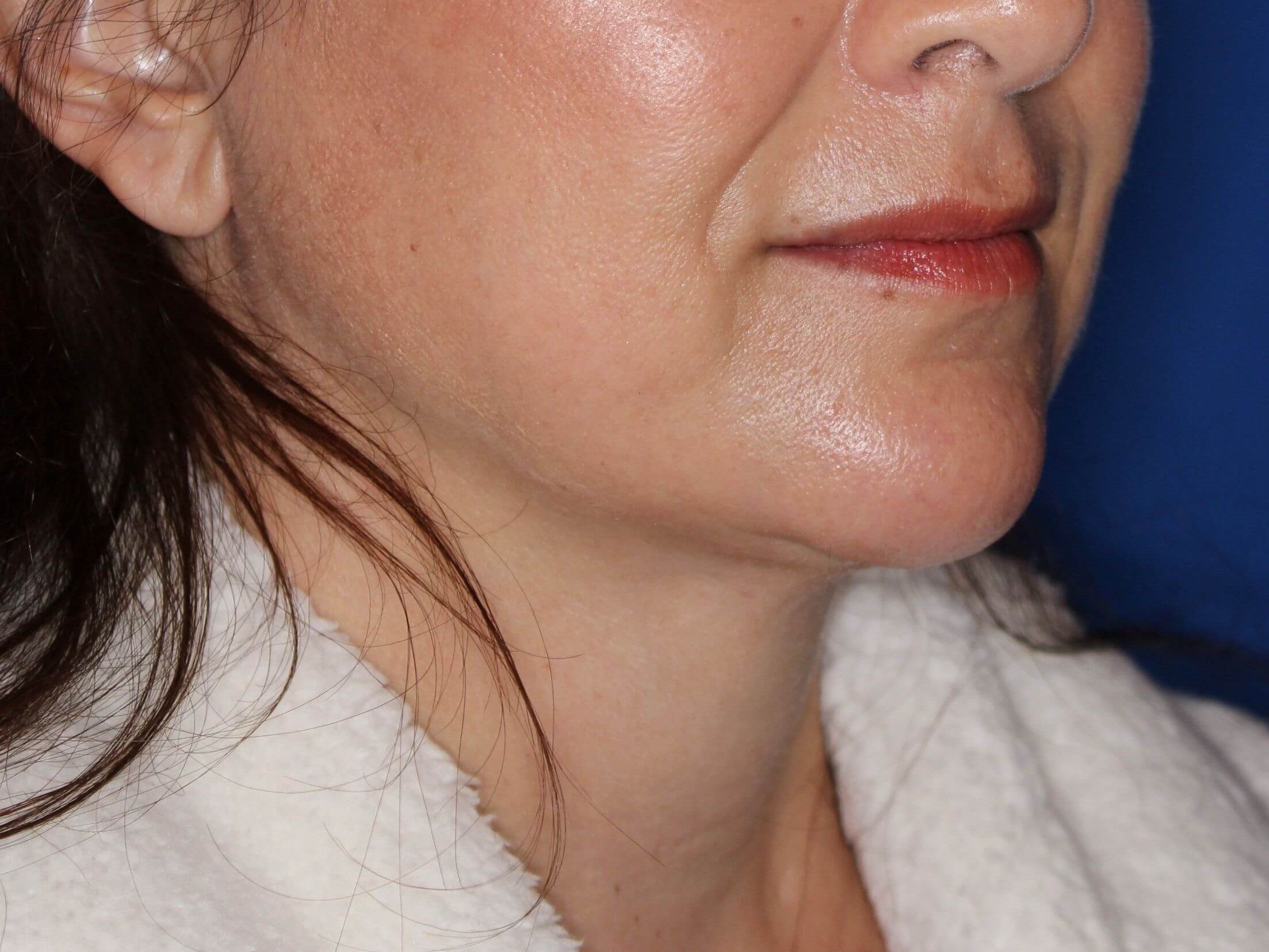 Nonsurgical Jaw Contouring After