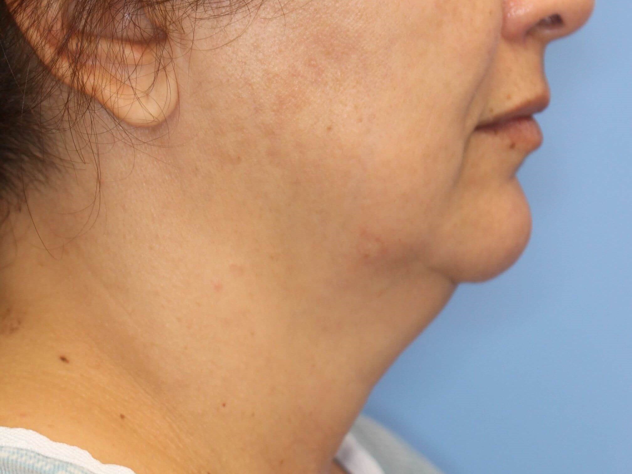 Nonsurgical Jaw Contouring Before