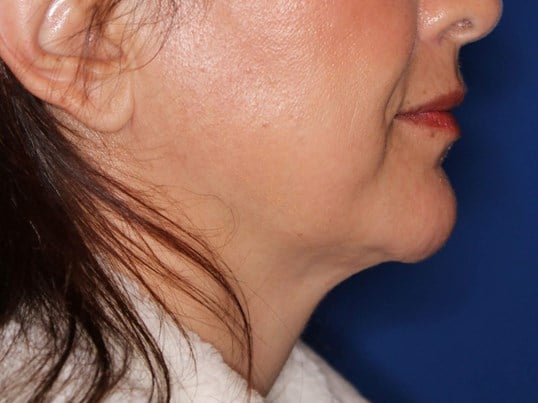 Nonsurgical Jaw Contouring After