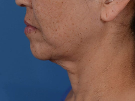 Nonsurgical Skin Tightening Before