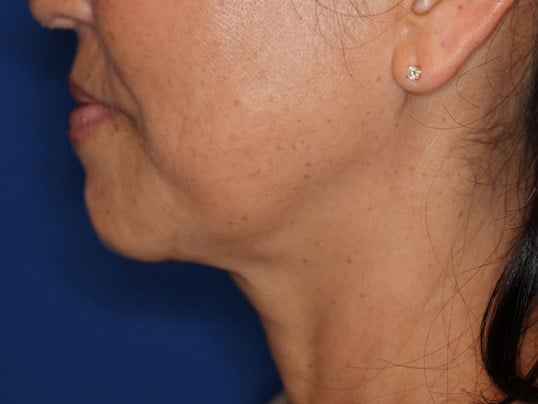 Nonsurgical Skin Tightening After