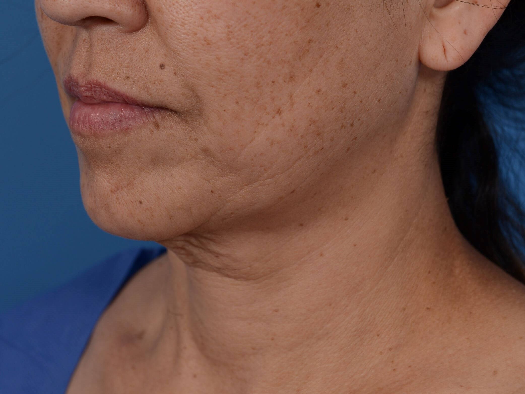 Nonsurgical Skin Tightening Before