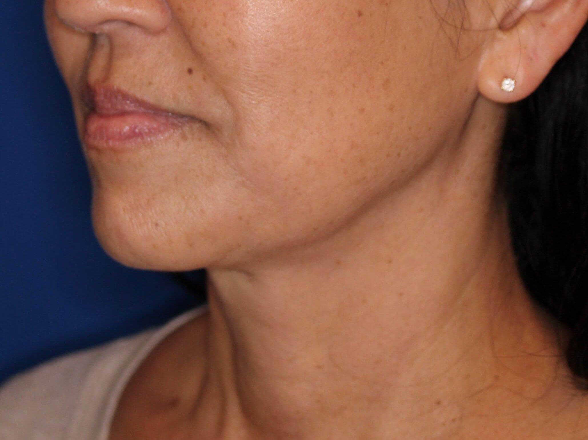 Nonsurgical Skin Tightening After