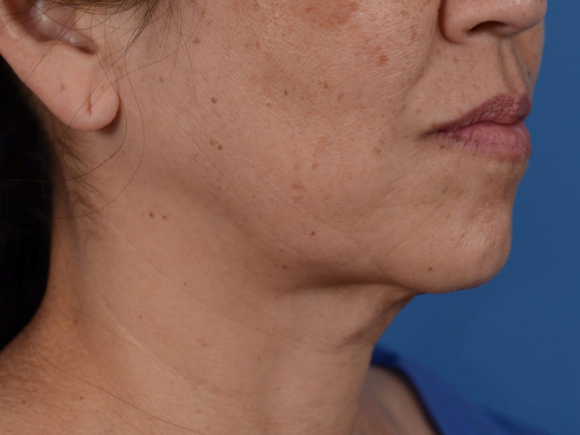 Nonsurgical Skin Tightening Before
