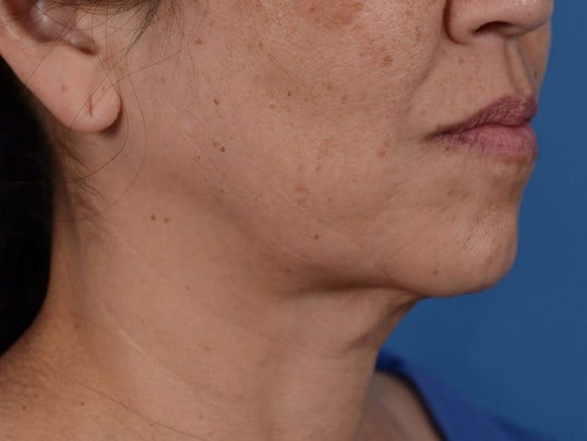 Nonsurgical Skin Tightening Before