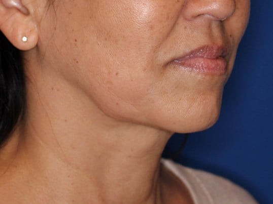 Nonsurgical Skin Tightening After