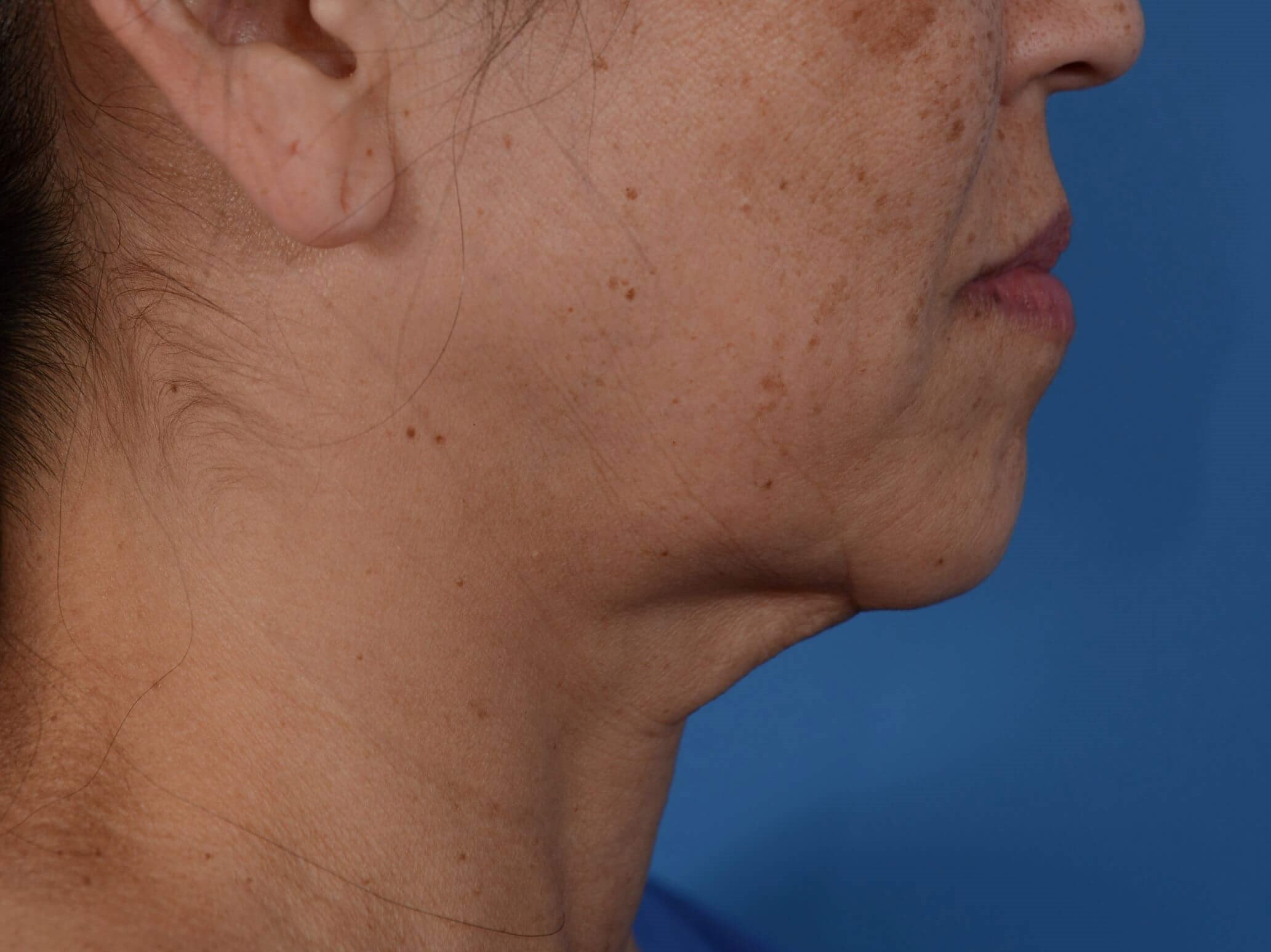 Nonsurgical Skin Tightening Before