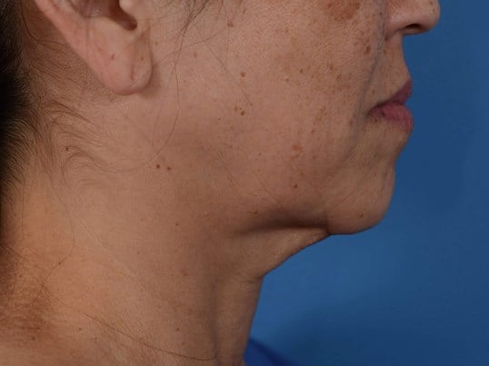 Nonsurgical Skin Tightening Before