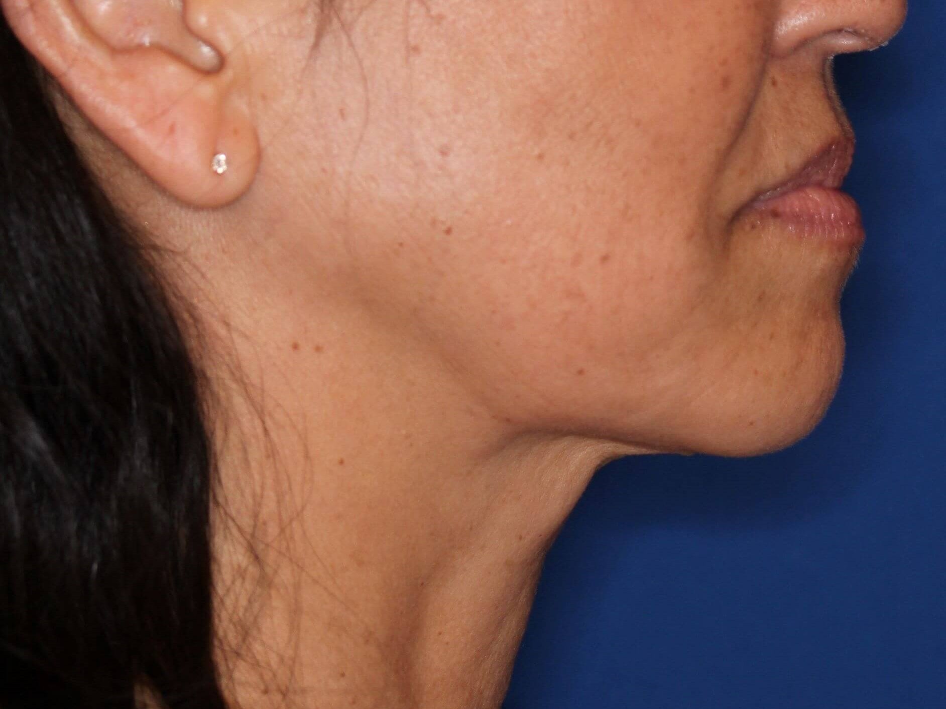 Nonsurgical Skin Tightening After