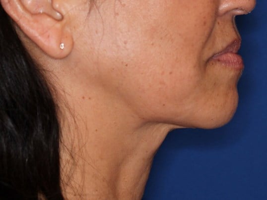 Nonsurgical Skin Tightening After