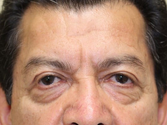 Lower Eyelid Lift Before