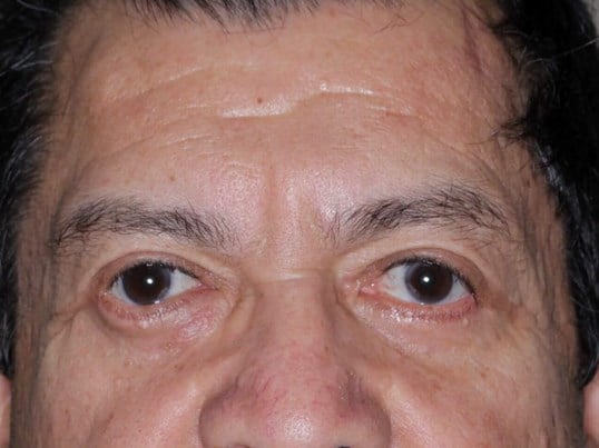 Lower Eyelid Lift After