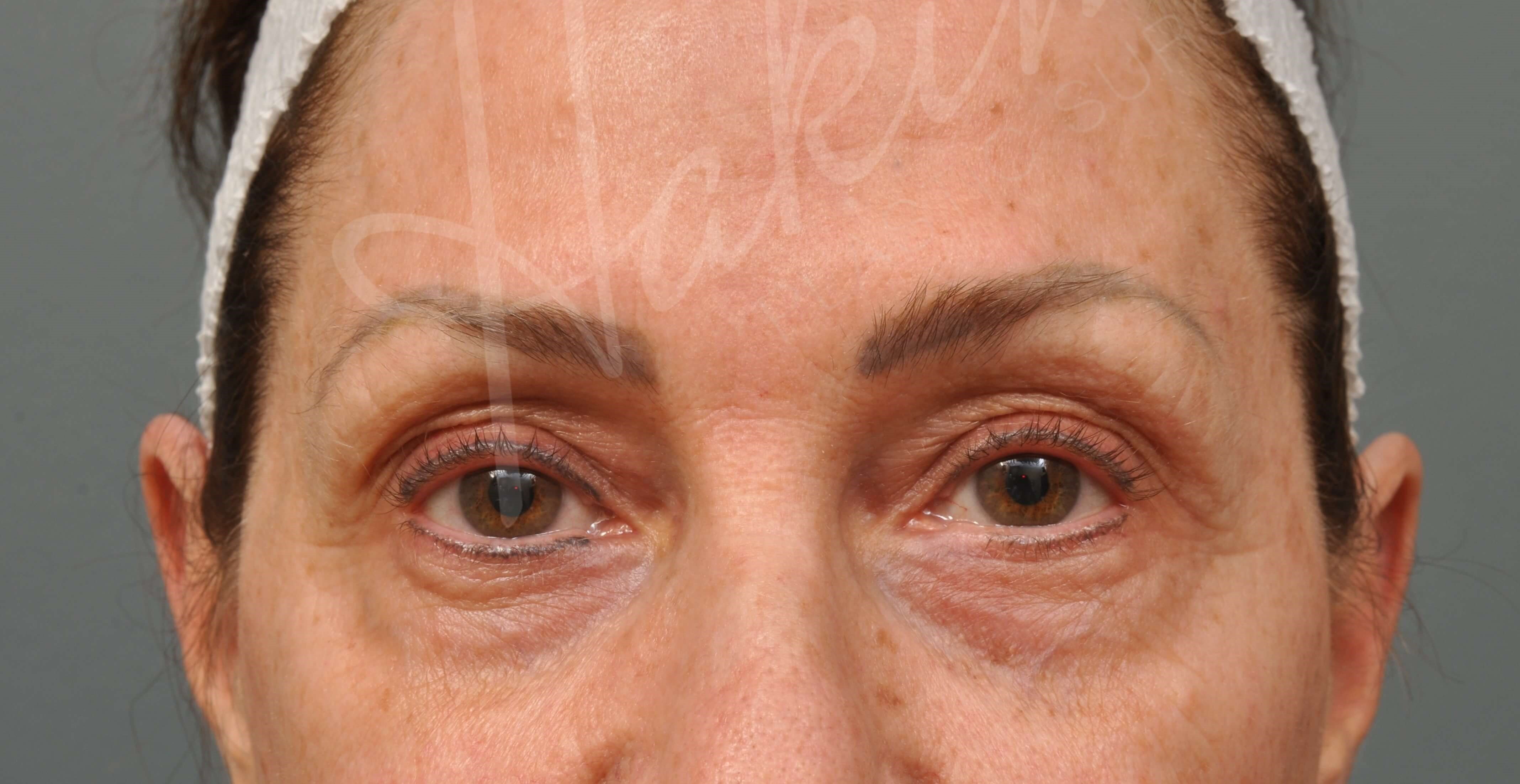 Lower Eyelid Lift Before