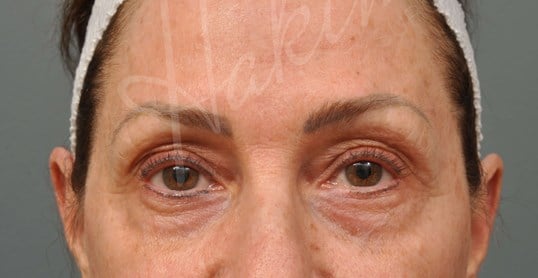 Lower Eyelid Lift Before
