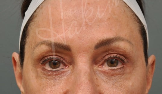 Lower Eyelid Lift After