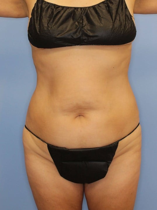 Tummy Tuck Before