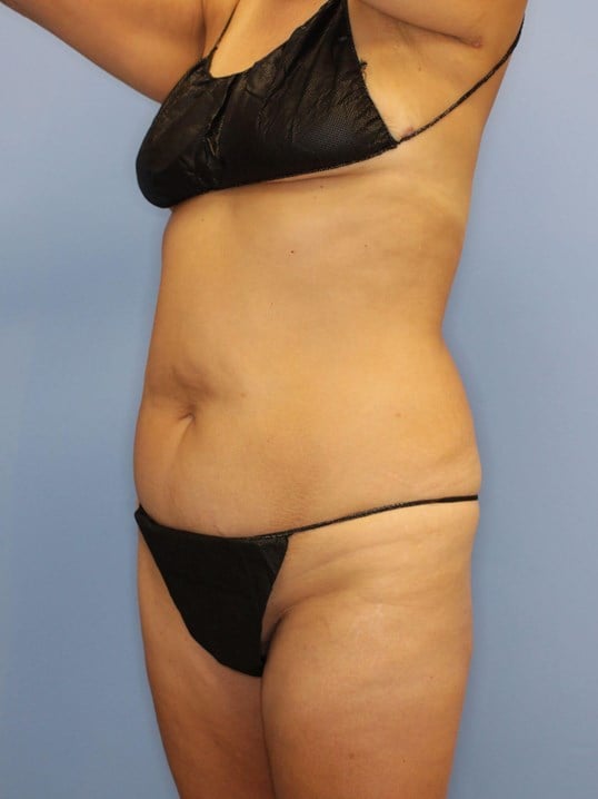 Tummy Tuck Before