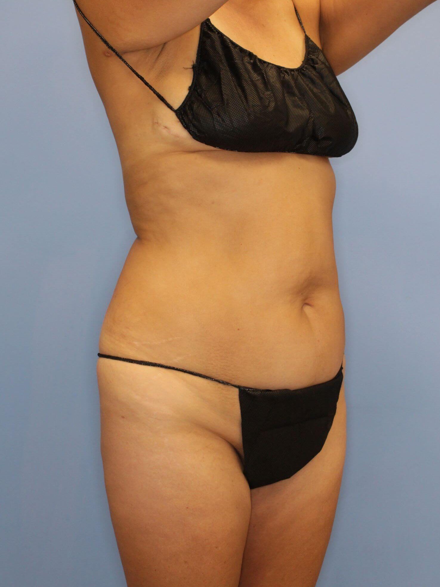 Tummy Tuck Before