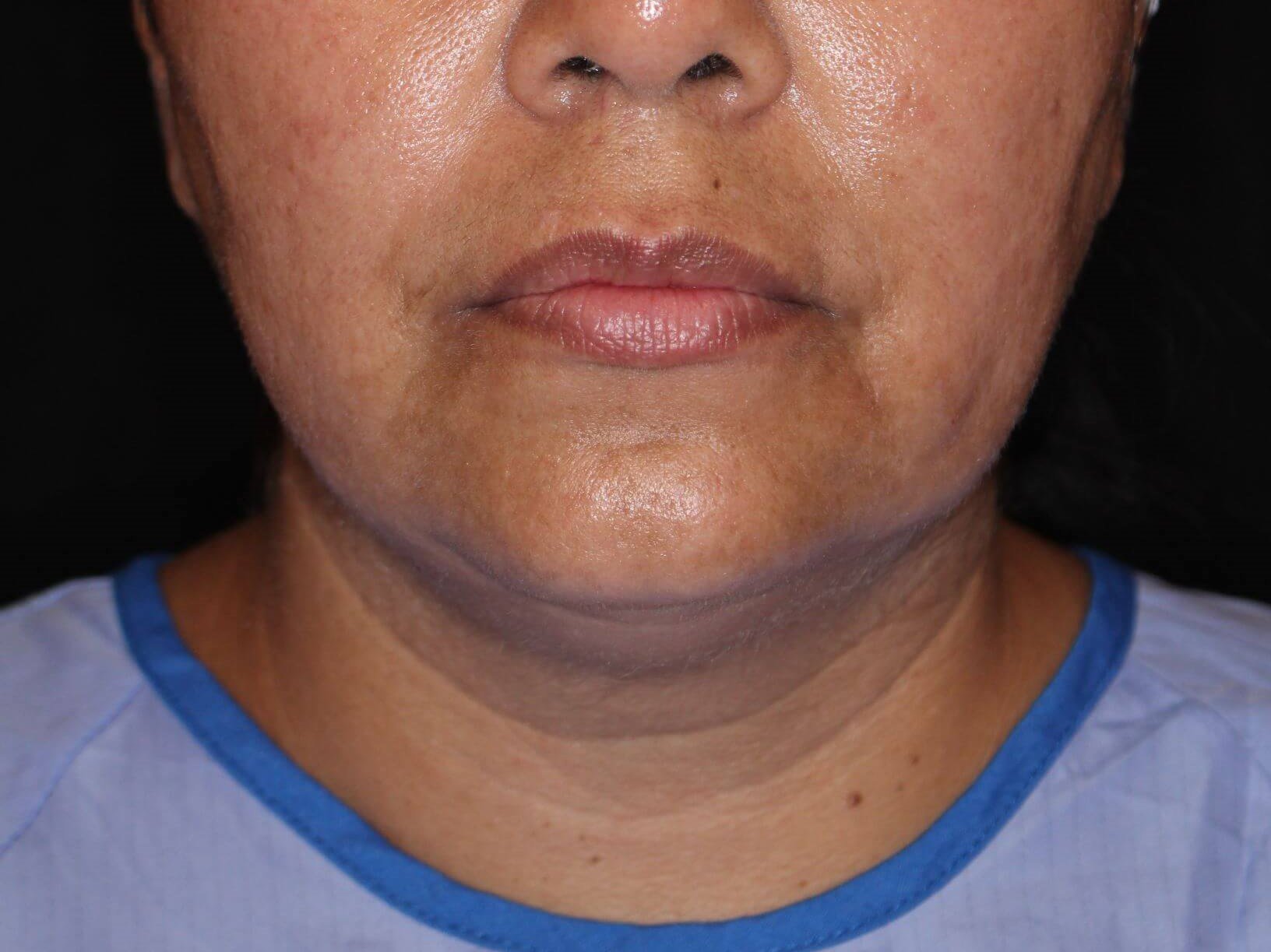 Double Chin Removal Before