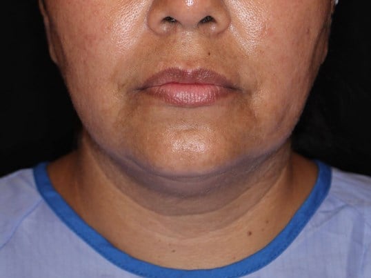 Double Chin Removal Before