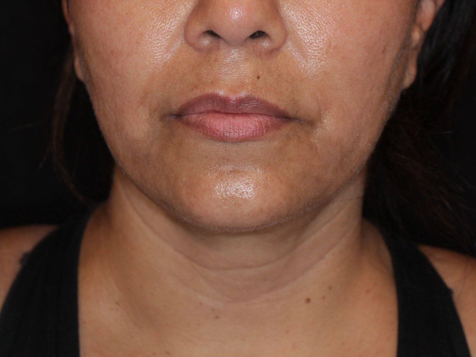 Double Chin Removal After