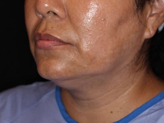 Double Chin Removal Before