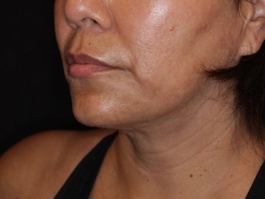 Double Chin Removal After