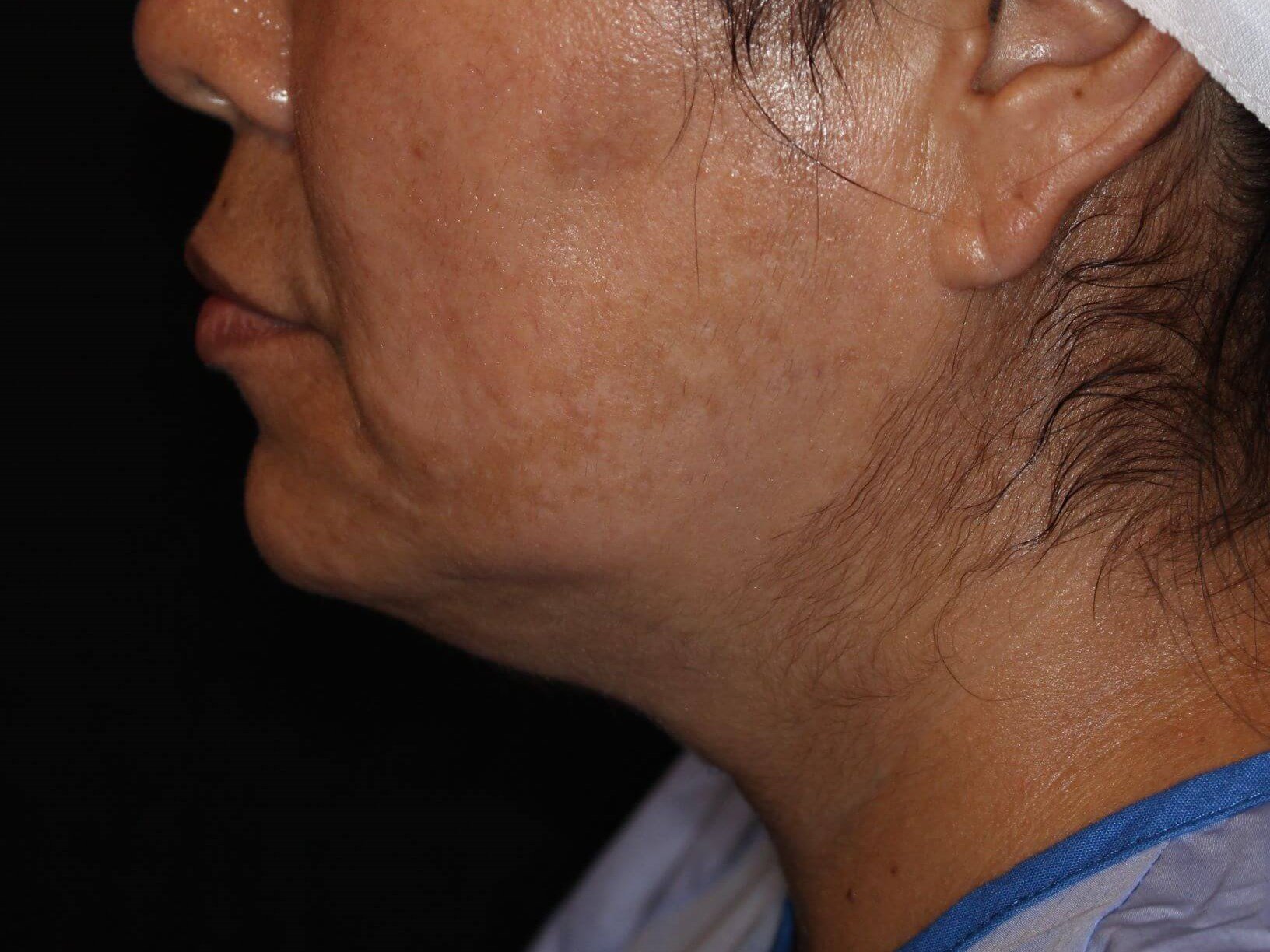 Double Chin Removal Before