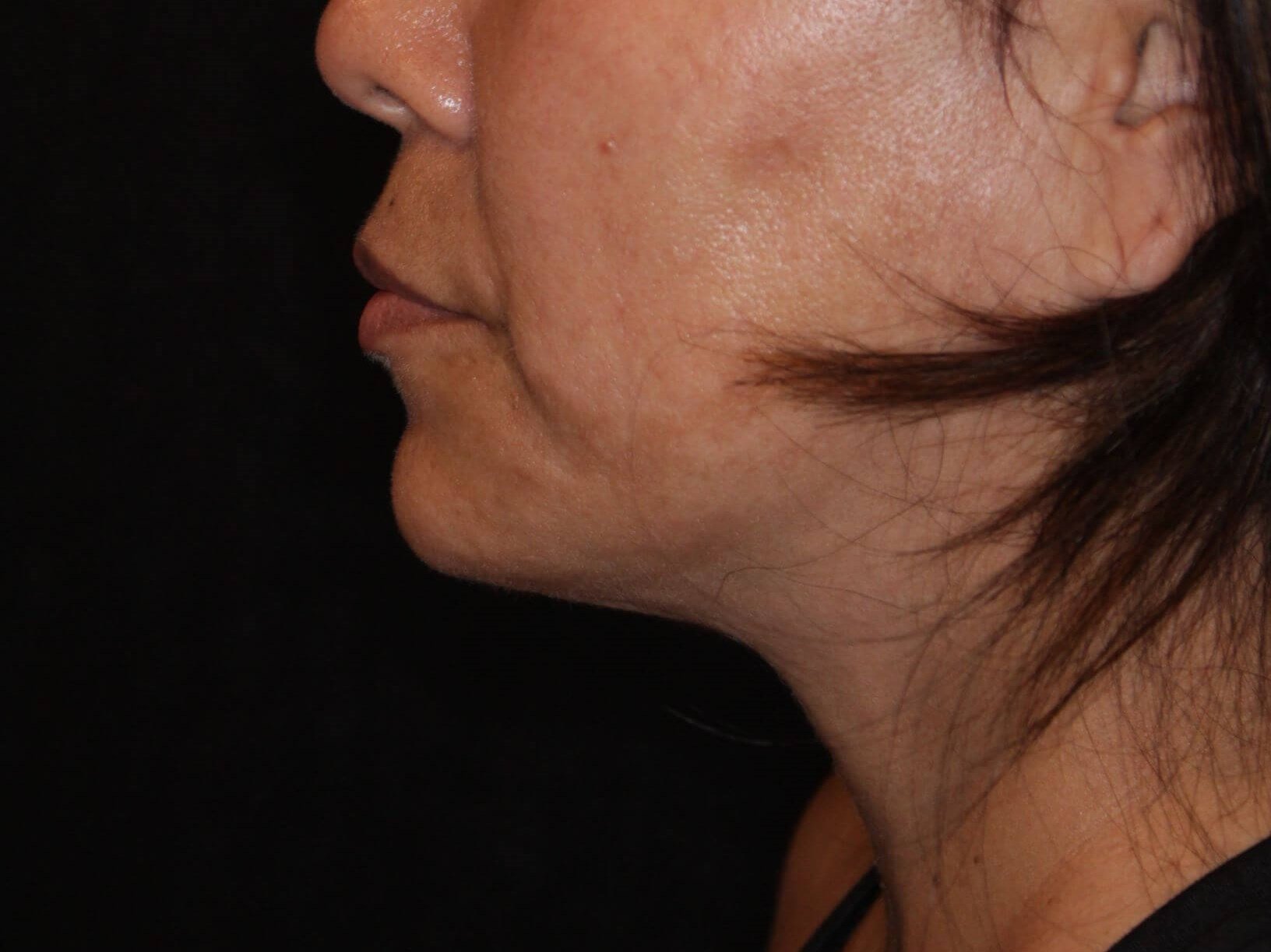 Double Chin Removal After