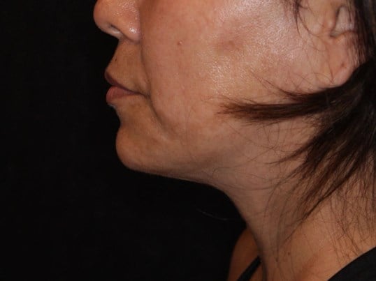 Double Chin Removal After