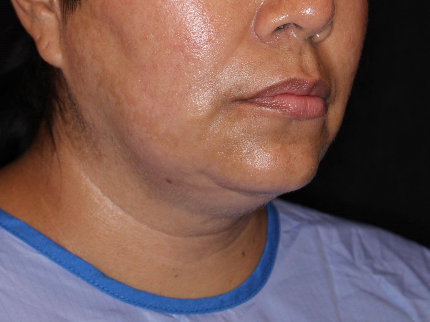 Double Chin Removal Before