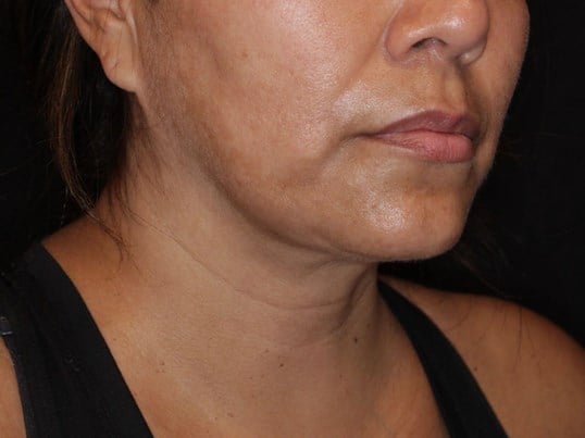 Double Chin Removal After