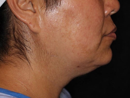 Double Chin Removal Before
