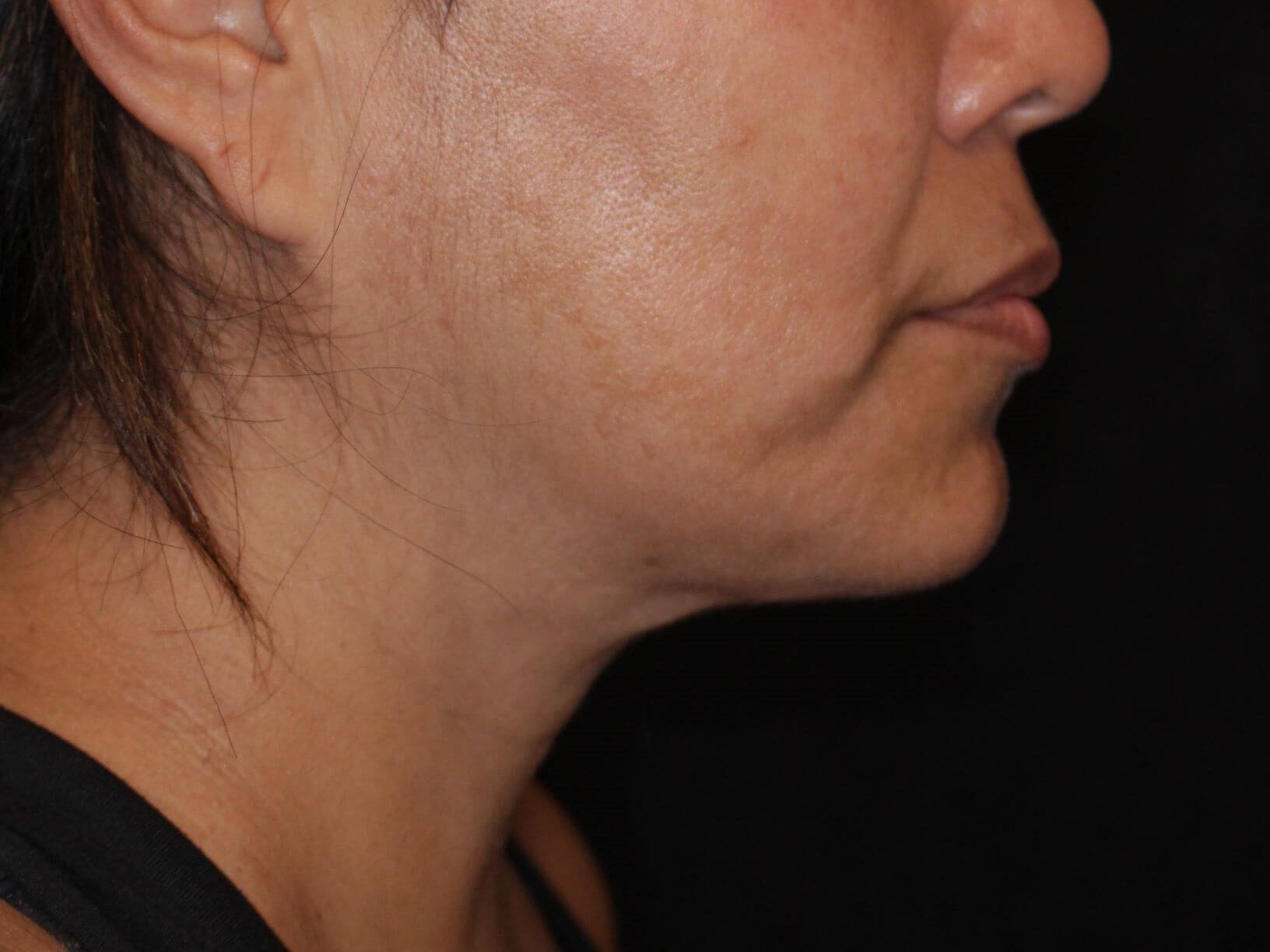 Double Chin Removal After