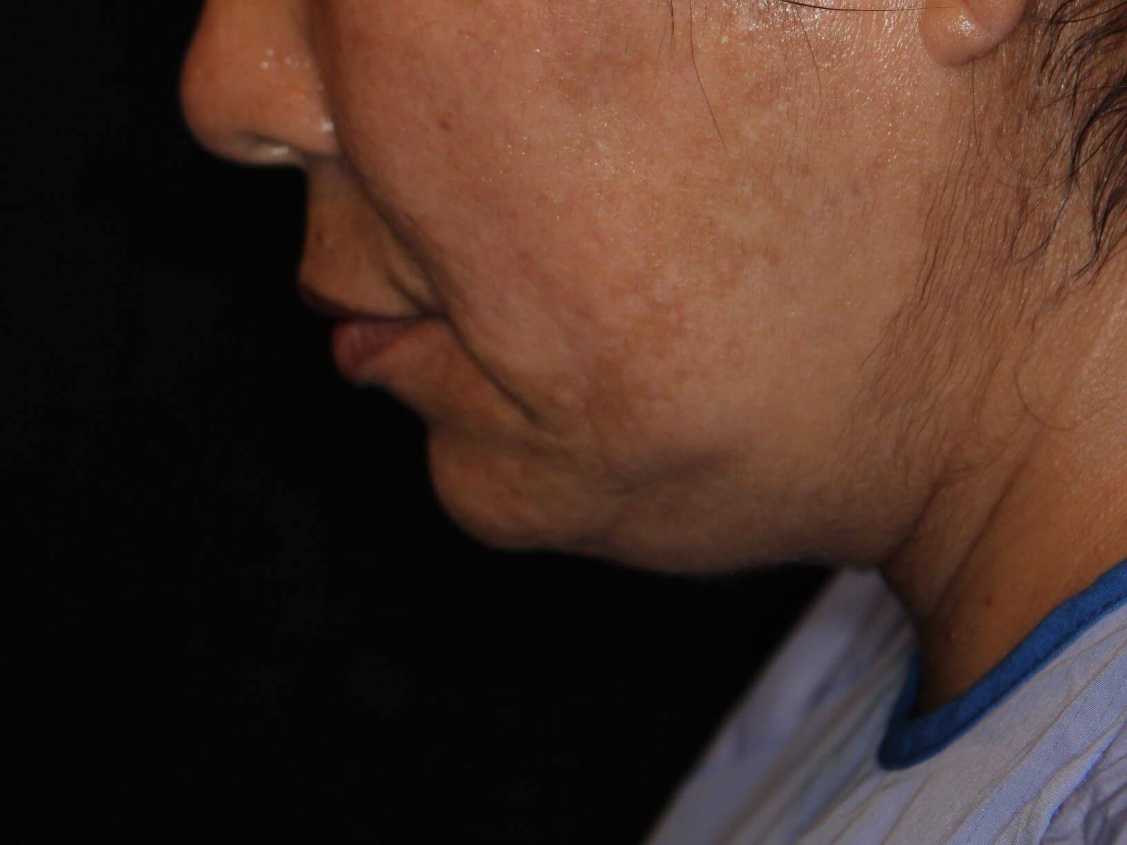 Double Chin Removal Before