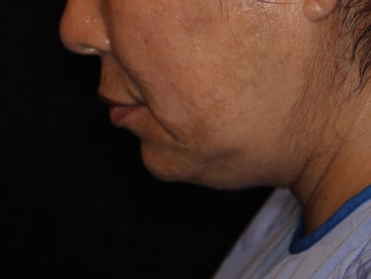 Double Chin Removal Before