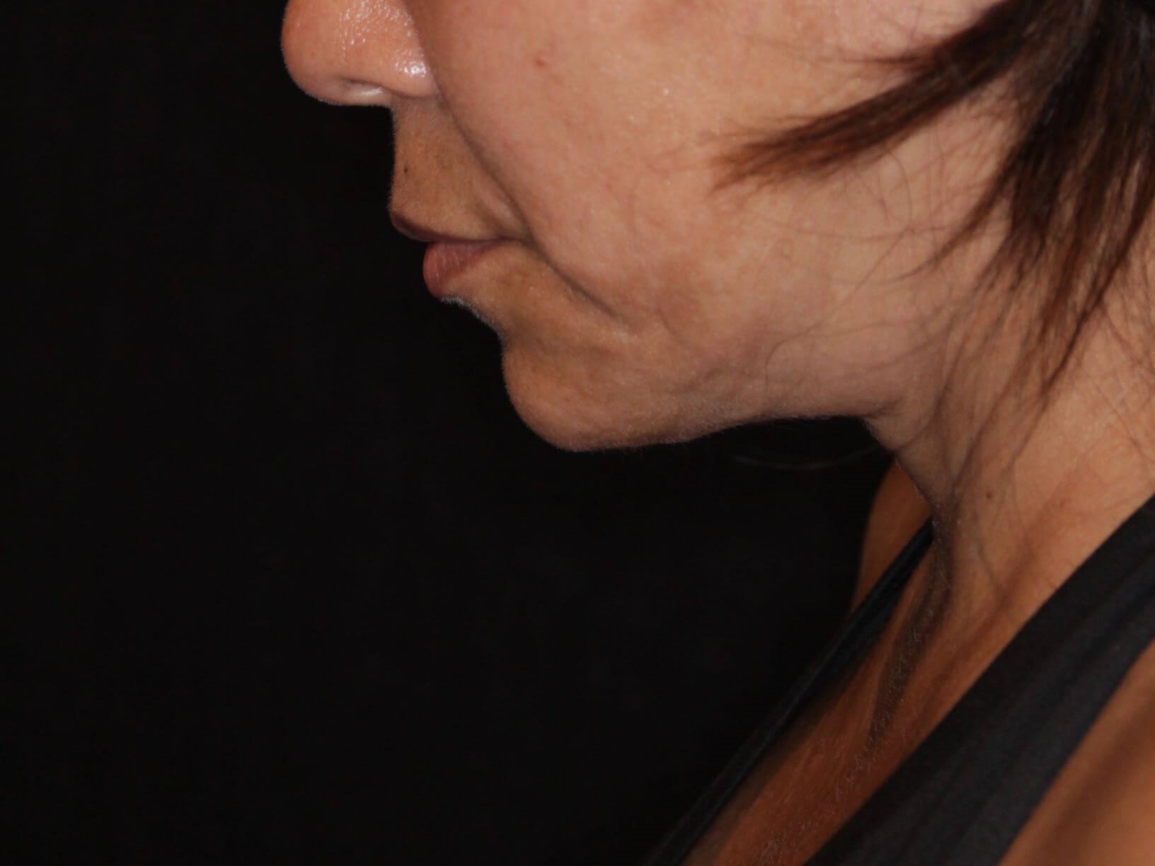 Double Chin Removal After