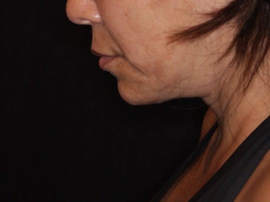 Double Chin Removal After